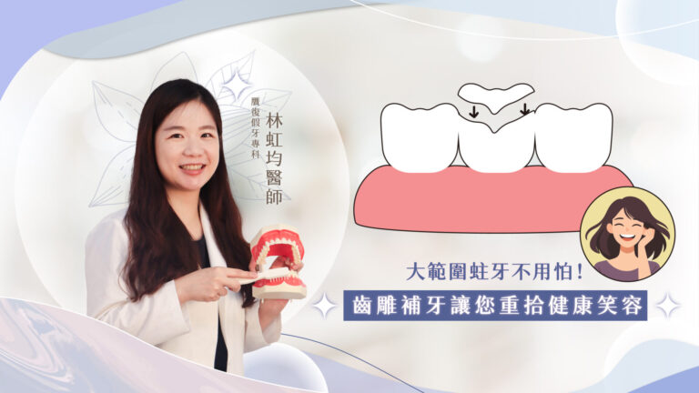 一聽到「蛀牙治療」，大家是不是就會聯想到：過去很多人會在嘴巴裡裝上大金牙？事實上，傳統的金屬假牙治療已經逐漸被新興的治療方式取代。近年來，兼具美觀和功能性的治療方式—陶瓷齒雕，漸漸受到大家的重視。陶瓷齒雕最大的優勢在於：相較於過去傳統的療程或是全瓷冠，不需要大幅度的磨損齒質，卻能達到幾乎和真牙一樣的自然效果和功能。