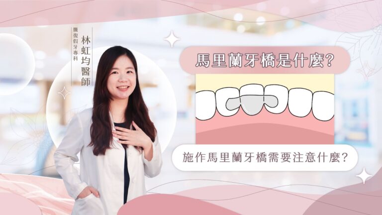 在臉書粉絲專頁中，我們曾經多次聊到馬里蘭牙橋，曾經聊到做馬里蘭牙橋的案例、有聊過其適應症，但是⋯⋯從來沒有聊過究竟馬里蘭牙橋是什麼？與傳統牙橋究竟差在哪。 今天，璽瑞美學牙醫診所，贋復假牙專科林虹均醫師，就要來帶大家進一步認識：馬里蘭牙橋。
