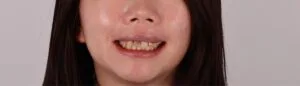 術前