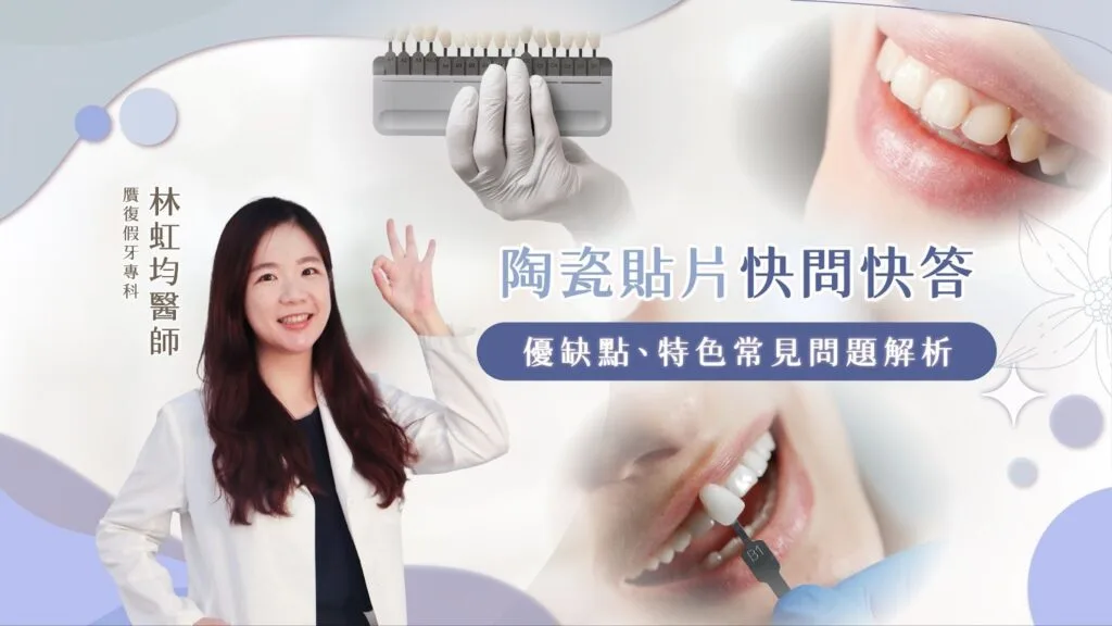 陶瓷貼片快問快答 優缺點、特色常見問題解析