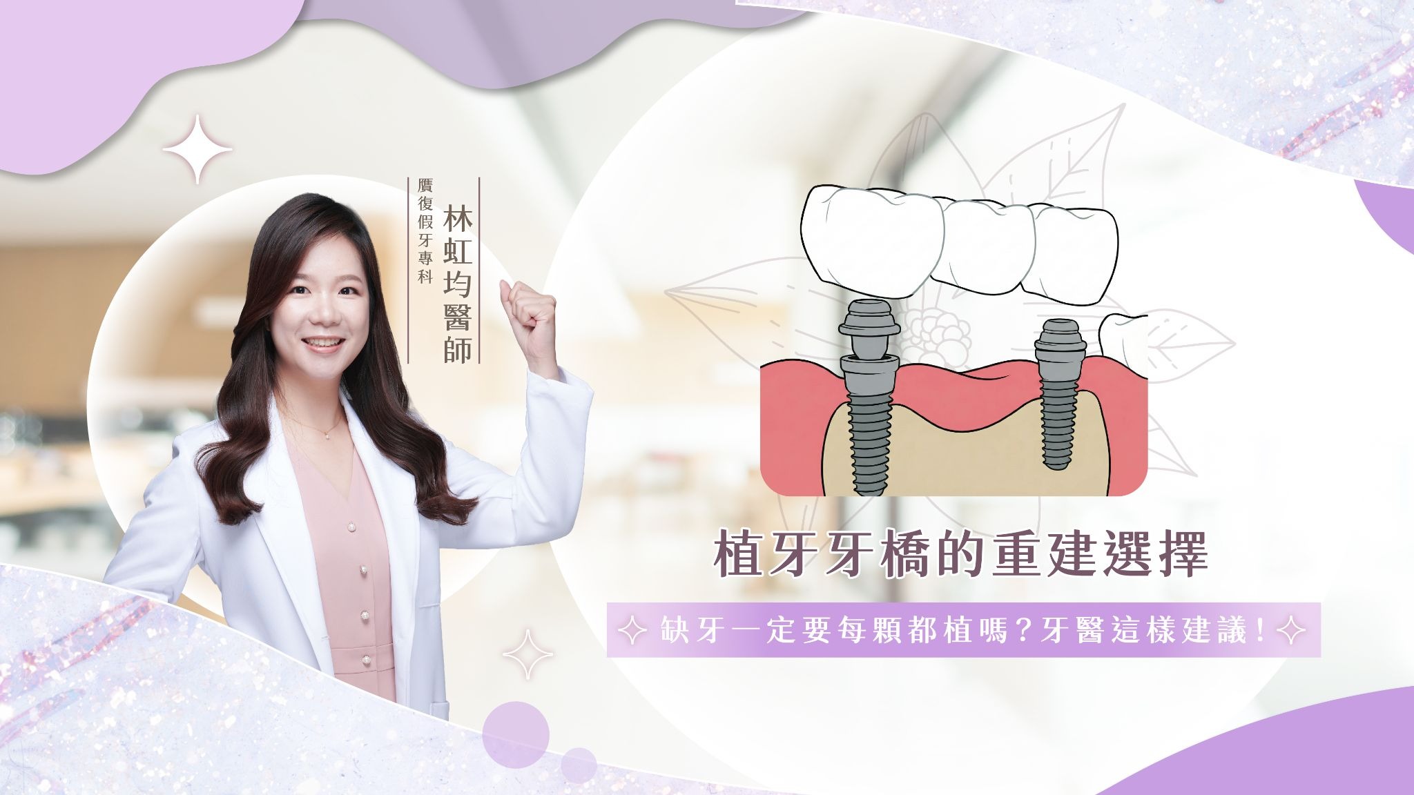 植牙牙橋的重建選擇｜缺牙一定要每顆都植嗎？牙醫這樣建議！