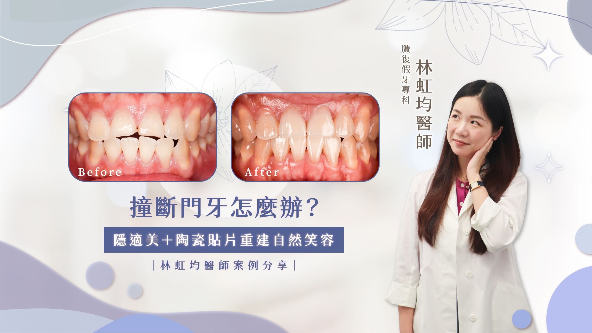 撞斷門牙怎麼辦？隱適美＋陶瓷貼片重建自然笑容｜林虹均醫師案例分享