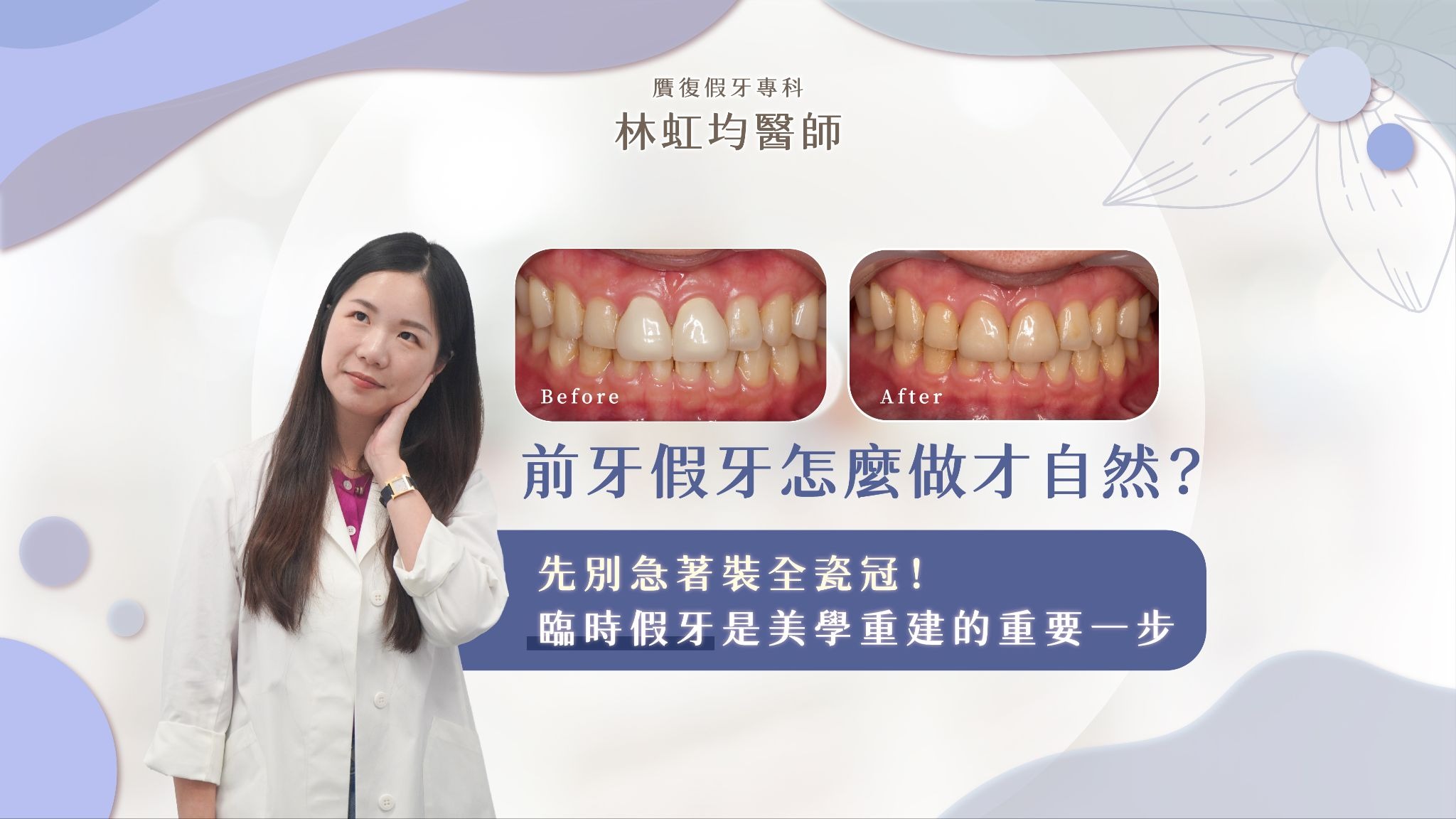 前牙假牙怎麼做才自然？先別急著裝全瓷冠！臨時假牙是美學重建的重要一步