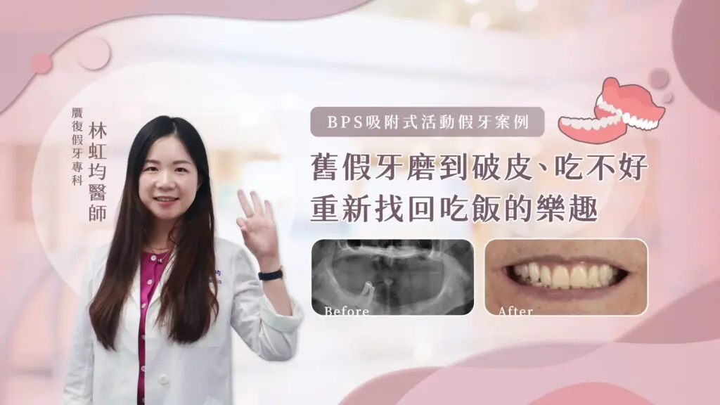 BPS吸附式活動假牙案例|舊假牙磨到破皮、吃不好,重新找回吃飯的樂趣