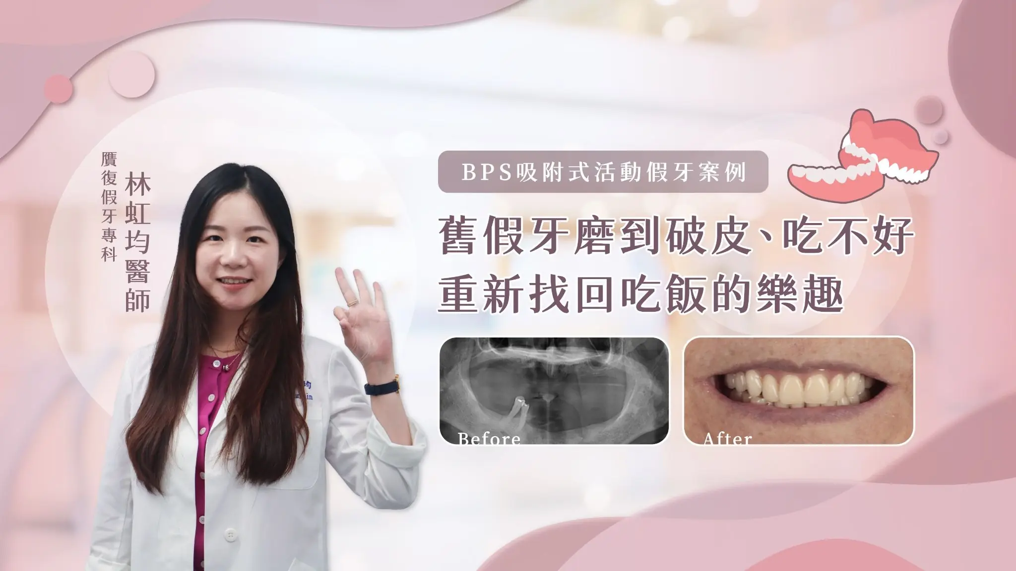 BPS吸附式活動假牙案例｜舊假牙磨到破皮、吃不好，重新找回吃飯的樂趣 活動假牙明明已經做了，為什麼長輩還是不想戴，甚至開始越吃越少？ 對許多高齡缺牙患者來說，真正影響生活的往往不只是「少了幾顆牙」，而是假牙戴起來會痛、容易鬆動，或吃東西時總覺得不好用。時間久了，原本應該幫助吃飯的假牙，反而被收進盒子裡。 這次來到診所的阿姨也是如此。下顎只剩兩顆牙的她，過去其實已經做過活動假牙，卻因為配戴不舒服、反覆磨破牙肉，漸漸變得不想戴、也吃不好。直到女兒擔心媽媽長期飲食受到影響，才陪著她重新評估，最後選擇製作上下顎的 BPS吸附式活動假牙。 BPS吸附式活動假牙本質上仍屬於活動假牙，可自行取下清潔，並非像植牙或固定式假牙一樣固定於口中。其製作著重於精細印模、咬合紀錄與邊緣設計，依患者的齒槽骨、牙肉及口腔條件進行規劃。若原有活動假牙容易鬆動、磨痛、造成異物感，甚至影響進食，可重新評估假牙與口腔條件，判斷是否適合調整、重新製作或評估BPS吸附式活動假牙。 BPS吸附式活動假牙案例｜從「吃不好」開始重新評估 舊活動假牙磨到破皮，讓阿姨越來越不想戴 第一次來到診所時，是女兒陪著阿姨一起來。當時阿姨的下顎只剩下兩顆牙齒，過去雖然曾經製作過活動假牙，但實際使用的經驗並不好。 假牙戴在口中不只不好使用，還經常摩擦牙肉，甚至磨到破皮。當每次吃飯都伴隨著不舒服，久而久之，阿姨不只東西吃不好，也越來越不願意配戴假牙。 女兒最擔心的，並不是媽媽少了幾顆牙，而是長期處在「吃不好」的狀態，可能連帶影響日常飲食與生活。因此才陪著媽媽來到診所，希望重新評估現在的口腔條件，看看還有沒有更適合她的活動假牙選擇。 重新評估口腔條件，製作上下顎BPS吸附式活動假牙 經過口內檢查與討論後，我們最後決定為阿姨重新製作上下顎的 BPS吸附式活動假牙。 活動假牙並不是單純把缺少的牙齒排列回去而已，假牙與口腔組織的貼合、邊緣延伸、上下顎咬合關係，都會影響實際配戴感受。因此在BPS假牙的製作過程中，會透過較精細的印模、咬合紀錄與假牙邊緣設計，依照患者當下的口腔條件進行規劃。 對曾經有過「假牙磨痛、戴不住」經驗的患者來說，重新製作時更重要的不是單純換一副新的，而是重新找出過去使用不舒服的原因，再依目前的口腔狀況調整假牙設計。 做完假牙後，阿姨開始期待「今天要吃什麼？」 這個案例最讓人開心的，其實不是BPS假牙完成的那一天。 後來我們聽到家人分享，阿姨開始會開心地去逛市場，看看今天有什麼想買、想吃的東西。從原本因為假牙不好用，吃東西總是有所顧忌，到現在重新開始期待「今天可以吃什麼」，這樣的生活轉變，反而是這次治療最有意義的地方。 假牙重建的目的，從來不只是把缺牙的位置補起來。對高齡患者而言，更實際的目標是讓假牙能夠真正回到生活裡，幫助吃飯、說話與日常使用，而不是做好之後，最後又因為不舒服被收進盒子裡。 BPS吸附式活動假牙是什麼？和一般活動假牙有什麼不同？ BPS吸附式活動假牙，本質上仍然是「活動假牙」 「吸附式」三個字很容易讓人誤以為，BPS假牙戴上去後就會像植牙或固定式假牙一樣牢牢固定，但其實不是。 BPS吸附式活動假牙本質上仍然屬於活動假牙，患者可以自行取下，也需要每天拆下來清潔。它的製作著重於印模、咬合紀錄、邊緣設計，以及假牙與口腔周圍組織之間的協調，希望依照個人口腔條件提升配戴時的穩定與舒適程度。 因此，BPS並不是把活動假牙「變成固定假牙」，每個人最終能達到的吸附效果與使用感受，也會受到齒槽骨、牙肉、唾液與口腔肌肉等條件影響，需要實際檢查後才能評估。 為什麼活動假牙會鬆、磨痛，甚至讓人不想戴？ 活動假牙不像植牙一樣固定於骨頭中，而是需要依靠剩餘牙齒、牙肉、齒槽脊及周圍組織提供支撐。當假牙與口腔組織的貼合或受力狀況不理想，就可能在吃飯、說話時產生移動，進一步摩擦牙肉，造成疼痛甚至破皮。 此外，活動假牙本身也具有一定的體積與吸附範圍，部分患者會覺得異物感比較明顯，甚至容易噁心、想吐。如果長時間仍無法適應這種異物感，即使有活動假牙，也可能因為「不想戴」而無法真正使用。 因此，遇到活動假牙戴不住、一直磨痛時，不一定只是使用者「不習慣」，也值得重新檢查假牙與目前口腔條件是否仍然合適。 BPS吸附式活動假牙也有極限，不是每個人都能達到一樣的效果 BPS假牙仍然是一種活動假牙，因此它能提供的咬合力量與穩定度，不能直接與天然牙或植牙支持的固定式假牙相比。 尤其每位患者剩餘牙齒數量、齒槽骨吸收程度、牙肉型態與口腔肌肉活動都不同，即使採用相同的BPS製作系統，實際配戴感受也可能有所差異。完成假牙後，也可能需要經過一段適應與回診調整，才能逐步找到比較舒服的使用方式。 對於因身體狀況、手術接受度、預算或其他因素而選擇活動假牙的患者來說，治療的重點並不是追求「像植牙一樣固定」，而是在活動假牙本身的條件與限制下，盡可能找到符合患者需求的重建方式。 活動假牙一直磨痛、戴不住？可以重新評估現在的口腔條件 如果家中長輩已經有活動假牙，卻因為容易鬆動、磨破牙肉、異物感明顯，漸漸變得不想戴，甚至連吃東西都受到影響，不一定只能繼續忍耐。 隨著缺牙時間增加，齒槽骨與牙肉條件也可能持續改變，過去製作的假牙未必一直適合現在的口腔狀況。重新檢查剩餘牙齒、齒槽骨、牙肉與原有假牙後，才能判斷是可以透過調整改善，還是需要重新製作活動假牙。 BPS吸附式活動假牙不是每位缺牙患者唯一的答案，也不是固定式假牙的替代品。真正重要的是從患者的身體條件、口腔狀況、飲食需求與生活習慣出發，找到一個患者願意戴、能夠實際使用的重建方式，讓「有假牙」真正成為「用得上的假牙」。
