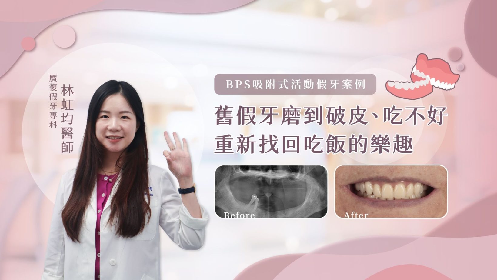 BPS吸附式活動假牙案例｜舊假牙磨到破皮、吃不好，重新找回吃飯的樂趣 活動假牙明明已經做了，為什麼長輩還是不想戴，甚至開始越吃越少？ 對許多高齡缺牙患者來說，真正影響生活的往往不只是「少了幾顆牙」，而是假牙戴起來會痛、容易鬆動，或吃東西時總覺得不好用。時間久了，原本應該幫助吃飯的假牙，反而被收進盒子裡。 這次來到診所的阿姨也是如此。下顎只剩兩顆牙的她，過去其實已經做過活動假牙，卻因為配戴不舒服、反覆磨破牙肉，漸漸變得不想戴、也吃不好。直到女兒擔心媽媽長期飲食受到影響，才陪著她重新評估，最後選擇製作上下顎的 BPS吸附式活動假牙。 BPS吸附式活動假牙本質上仍屬於活動假牙，可自行取下清潔，並非像植牙或固定式假牙一樣固定於口中。其製作著重於精細印模、咬合紀錄與邊緣設計，依患者的齒槽骨、牙肉及口腔條件進行規劃。若原有活動假牙容易鬆動、磨痛、造成異物感，甚至影響進食，可重新評估假牙與口腔條件，判斷是否適合調整、重新製作或評估BPS吸附式活動假牙。 BPS吸附式活動假牙案例｜從「吃不好」開始重新評估 舊活動假牙磨到破皮，讓阿姨越來越不想戴 第一次來到診所時，是女兒陪著阿姨一起來。當時阿姨的下顎只剩下兩顆牙齒，過去雖然曾經製作過活動假牙，但實際使用的經驗並不好。 假牙戴在口中不只不好使用，還經常摩擦牙肉，甚至磨到破皮。當每次吃飯都伴隨著不舒服，久而久之，阿姨不只東西吃不好，也越來越不願意配戴假牙。 女兒最擔心的，並不是媽媽少了幾顆牙，而是長期處在「吃不好」的狀態，可能連帶影響日常飲食與生活。因此才陪著媽媽來到診所，希望重新評估現在的口腔條件，看看還有沒有更適合她的活動假牙選擇。 重新評估口腔條件，製作上下顎BPS吸附式活動假牙 經過口內檢查與討論後，我們最後決定為阿姨重新製作上下顎的 BPS吸附式活動假牙。 活動假牙並不是單純把缺少的牙齒排列回去而已，假牙與口腔組織的貼合、邊緣延伸、上下顎咬合關係，都會影響實際配戴感受。因此在BPS假牙的製作過程中，會透過較精細的印模、咬合紀錄與假牙邊緣設計，依照患者當下的口腔條件進行規劃。 對曾經有過「假牙磨痛、戴不住」經驗的患者來說，重新製作時更重要的不是單純換一副新的，而是重新找出過去使用不舒服的原因，再依目前的口腔狀況調整假牙設計。 做完假牙後，阿姨開始期待「今天要吃什麼？」 這個案例最讓人開心的，其實不是BPS假牙完成的那一天。 後來我們聽到家人分享，阿姨開始會開心地去逛市場，看看今天有什麼想買、想吃的東西。從原本因為假牙不好用，吃東西總是有所顧忌，到現在重新開始期待「今天可以吃什麼」，這樣的生活轉變，反而是這次治療最有意義的地方。 假牙重建的目的，從來不只是把缺牙的位置補起來。對高齡患者而言，更實際的目標是讓假牙能夠真正回到生活裡，幫助吃飯、說話與日常使用，而不是做好之後，最後又因為不舒服被收進盒子裡。 BPS吸附式活動假牙是什麼？和一般活動假牙有什麼不同？ BPS吸附式活動假牙，本質上仍然是「活動假牙」 「吸附式」三個字很容易讓人誤以為，BPS假牙戴上去後就會像植牙或固定式假牙一樣牢牢固定，但其實不是。 BPS吸附式活動假牙本質上仍然屬於活動假牙，患者可以自行取下，也需要每天拆下來清潔。它的製作著重於印模、咬合紀錄、邊緣設計，以及假牙與口腔周圍組織之間的協調，希望依照個人口腔條件提升配戴時的穩定與舒適程度。 因此，BPS並不是把活動假牙「變成固定假牙」，每個人最終能達到的吸附效果與使用感受，也會受到齒槽骨、牙肉、唾液與口腔肌肉等條件影響，需要實際檢查後才能評估。 為什麼活動假牙會鬆、磨痛，甚至讓人不想戴？ 活動假牙不像植牙一樣固定於骨頭中，而是需要依靠剩餘牙齒、牙肉、齒槽脊及周圍組織提供支撐。當假牙與口腔組織的貼合或受力狀況不理想，就可能在吃飯、說話時產生移動，進一步摩擦牙肉，造成疼痛甚至破皮。 此外，活動假牙本身也具有一定的體積與吸附範圍，部分患者會覺得異物感比較明顯，甚至容易噁心、想吐。如果長時間仍無法適應這種異物感，即使有活動假牙，也可能因為「不想戴」而無法真正使用。 因此，遇到活動假牙戴不住、一直磨痛時，不一定只是使用者「不習慣」，也值得重新檢查假牙與目前口腔條件是否仍然合適。 BPS吸附式活動假牙也有極限，不是每個人都能達到一樣的效果 BPS假牙仍然是一種活動假牙，因此它能提供的咬合力量與穩定度，不能直接與天然牙或植牙支持的固定式假牙相比。 尤其每位患者剩餘牙齒數量、齒槽骨吸收程度、牙肉型態與口腔肌肉活動都不同，即使採用相同的BPS製作系統，實際配戴感受也可能有所差異。完成假牙後，也可能需要經過一段適應與回診調整，才能逐步找到比較舒服的使用方式。 對於因身體狀況、手術接受度、預算或其他因素而選擇活動假牙的患者來說，治療的重點並不是追求「像植牙一樣固定」，而是在活動假牙本身的條件與限制下，盡可能找到符合患者需求的重建方式。 活動假牙一直磨痛、戴不住？可以重新評估現在的口腔條件 如果家中長輩已經有活動假牙，卻因為容易鬆動、磨破牙肉、異物感明顯，漸漸變得不想戴，甚至連吃東西都受到影響，不一定只能繼續忍耐。 隨著缺牙時間增加，齒槽骨與牙肉條件也可能持續改變，過去製作的假牙未必一直適合現在的口腔狀況。重新檢查剩餘牙齒、齒槽骨、牙肉與原有假牙後，才能判斷是可以透過調整改善，還是需要重新製作活動假牙。 BPS吸附式活動假牙不是每位缺牙患者唯一的答案，也不是固定式假牙的替代品。真正重要的是從患者的身體條件、口腔狀況、飲食需求與生活習慣出發，找到一個患者願意戴、能夠實際使用的重建方式，讓「有假牙」真正成為「用得上的假牙」。