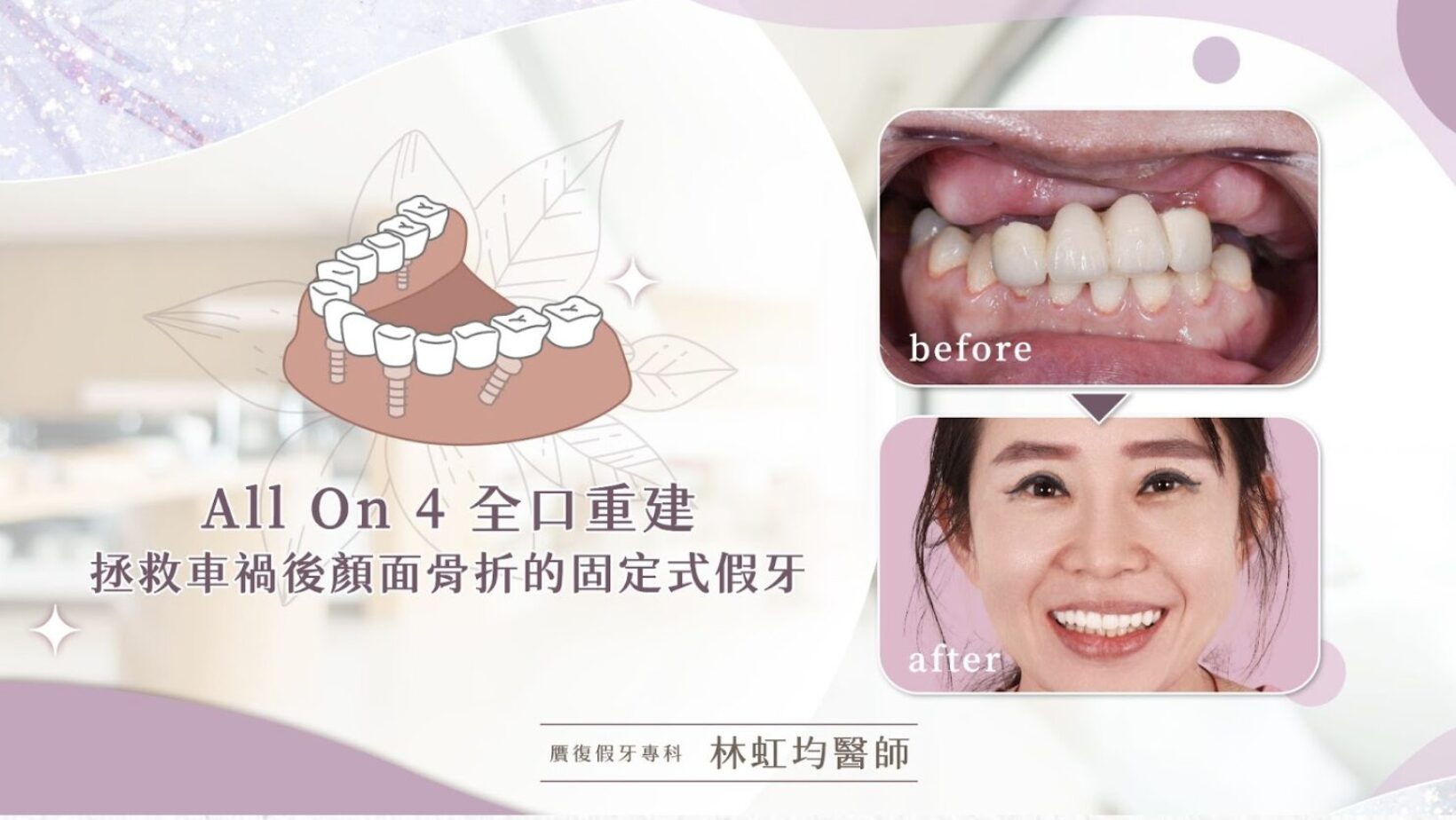 大家對All On 4有多深的認識呢？是專門為了「全口無牙」、「骨頭狀況很不好」的患者設計的療程嗎？又是依照什麼原理製作而成的呢？今天想跟大家好好分享前一陣子剛完成的All On 4案例，All On 4能做到的、對大家的幫助，一定比大家的想像多更多。